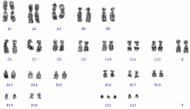 Лишняя 21 хромосома